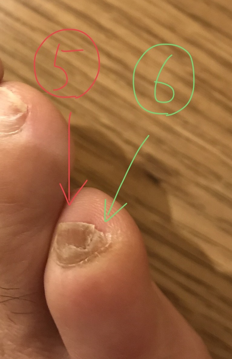 足 の 小指 の 爪 割れる