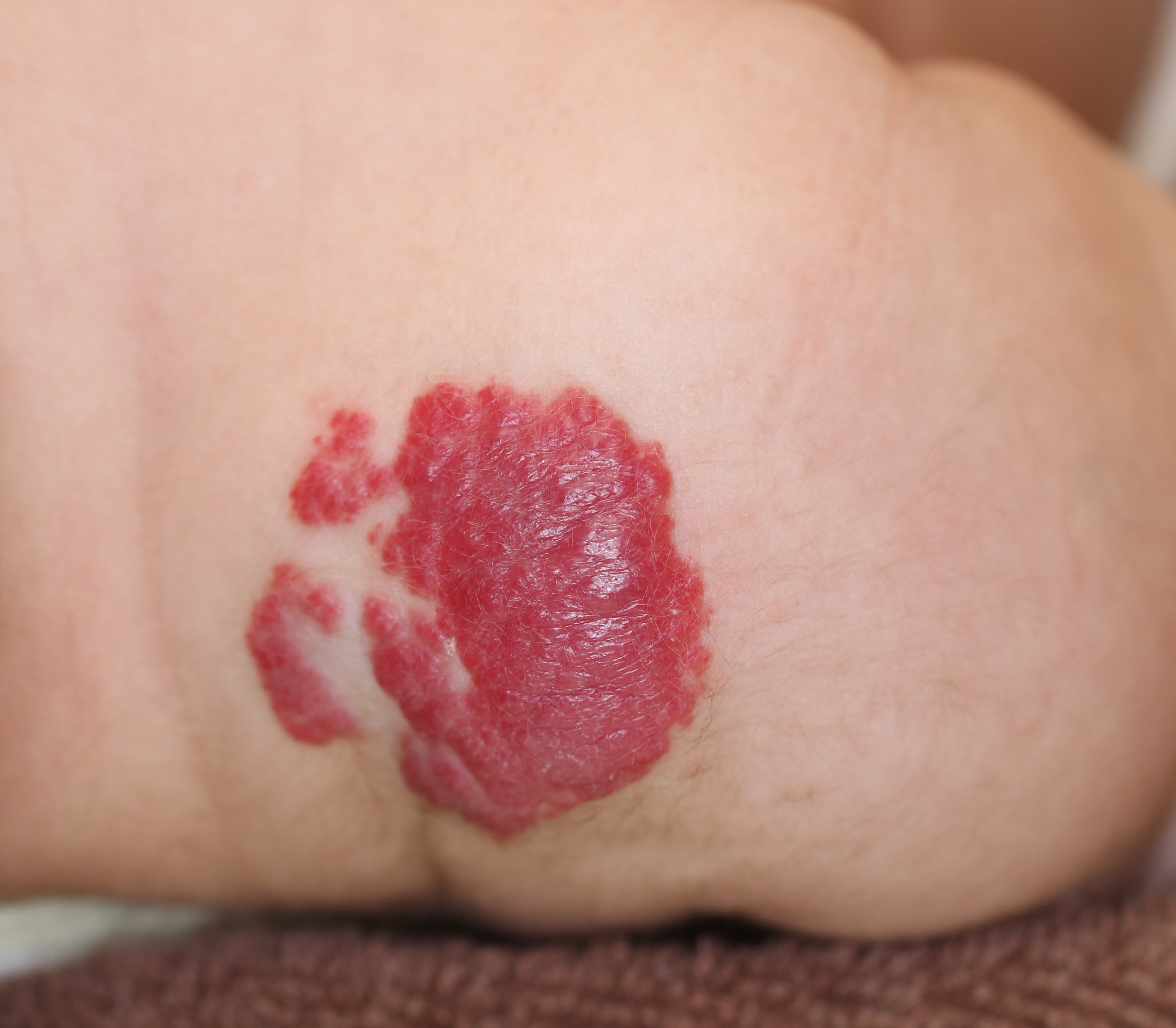 [最も人気のある！] 赤ちゃん 血管腫 画像 237061赤ちゃん 血管腫 画像