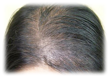 女性の薄毛ためのヘアサプリメント。Ogshi（おぐし）｜ 院長ブログ