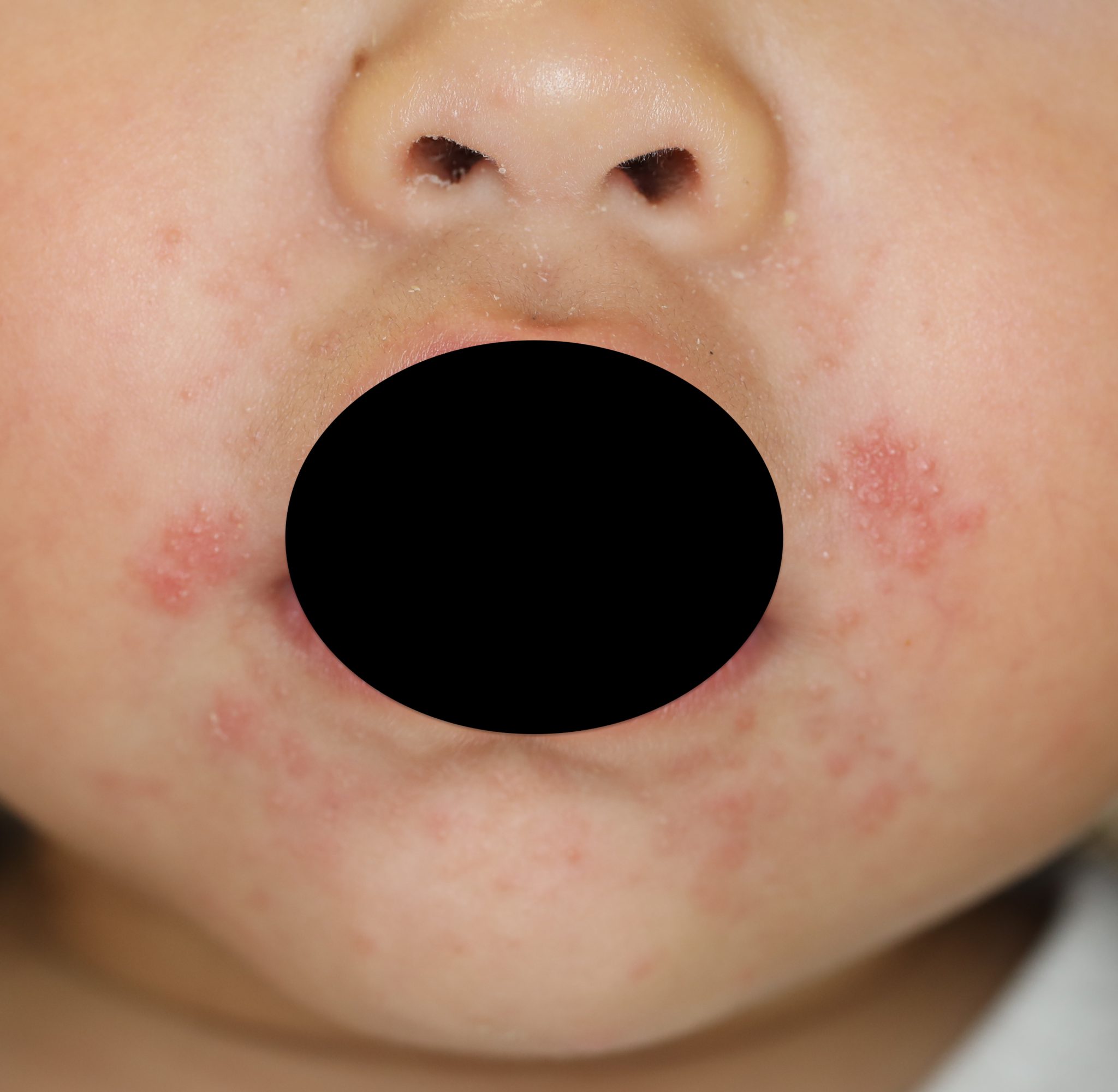 口の周りの湿疹ぶつぶつが治らない。子供にも多い口囲皮膚炎｜ 院長ブログ 咲くらクリニック