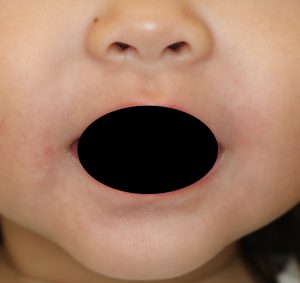 口の周りの湿疹ぶつぶつが治らない 子供にも多い口囲皮膚炎 院長ブログ 咲くらクリニック