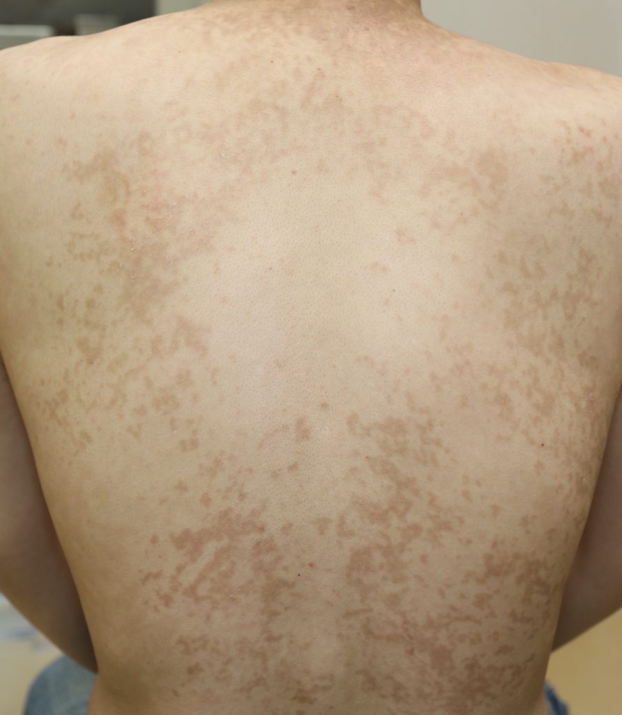 背中や胸にステロイドが効かない赤い痒い発疹がある。色素性痒疹では？